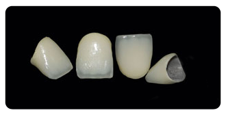 Anterior Crowns